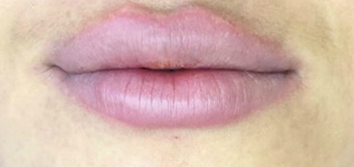 Lip augmentation