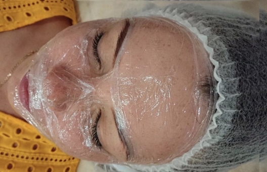 Чистка обличчя у «Perfect Cosmetology» у Києві. Записуйся по знижці.