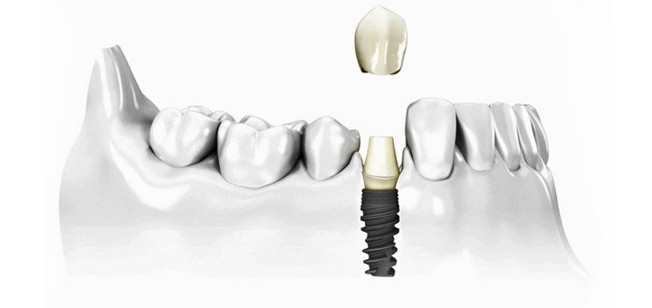 Promotional offer in the dental department of the clinic of aesthetic medicine «Ex Tempore»