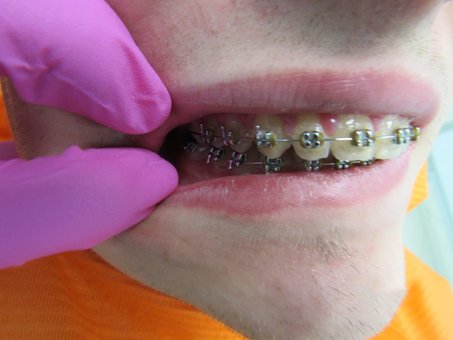 Installation of braces in the dental clinic «Orto Complex» in Kiev. Sign up for a consultation with an orthodontist at a discount.